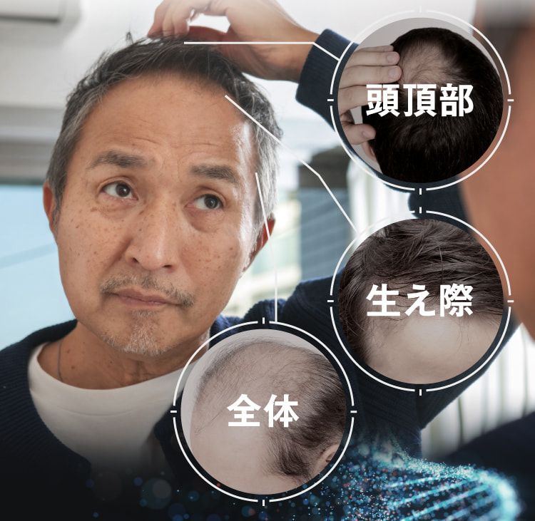 頭頂部 生え際 全体