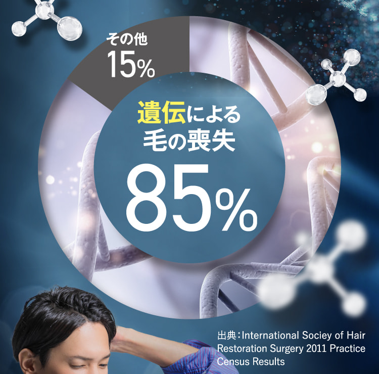 遺伝による毛の喪失85%