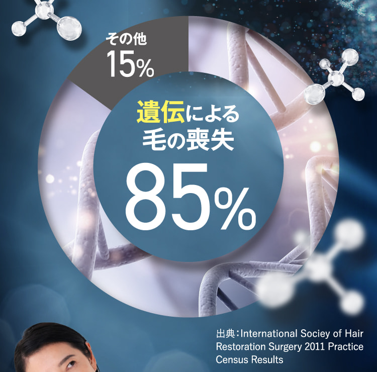 遺伝による毛の喪失85%